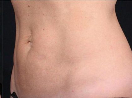TruSculpt ID Before & After Patient #1563